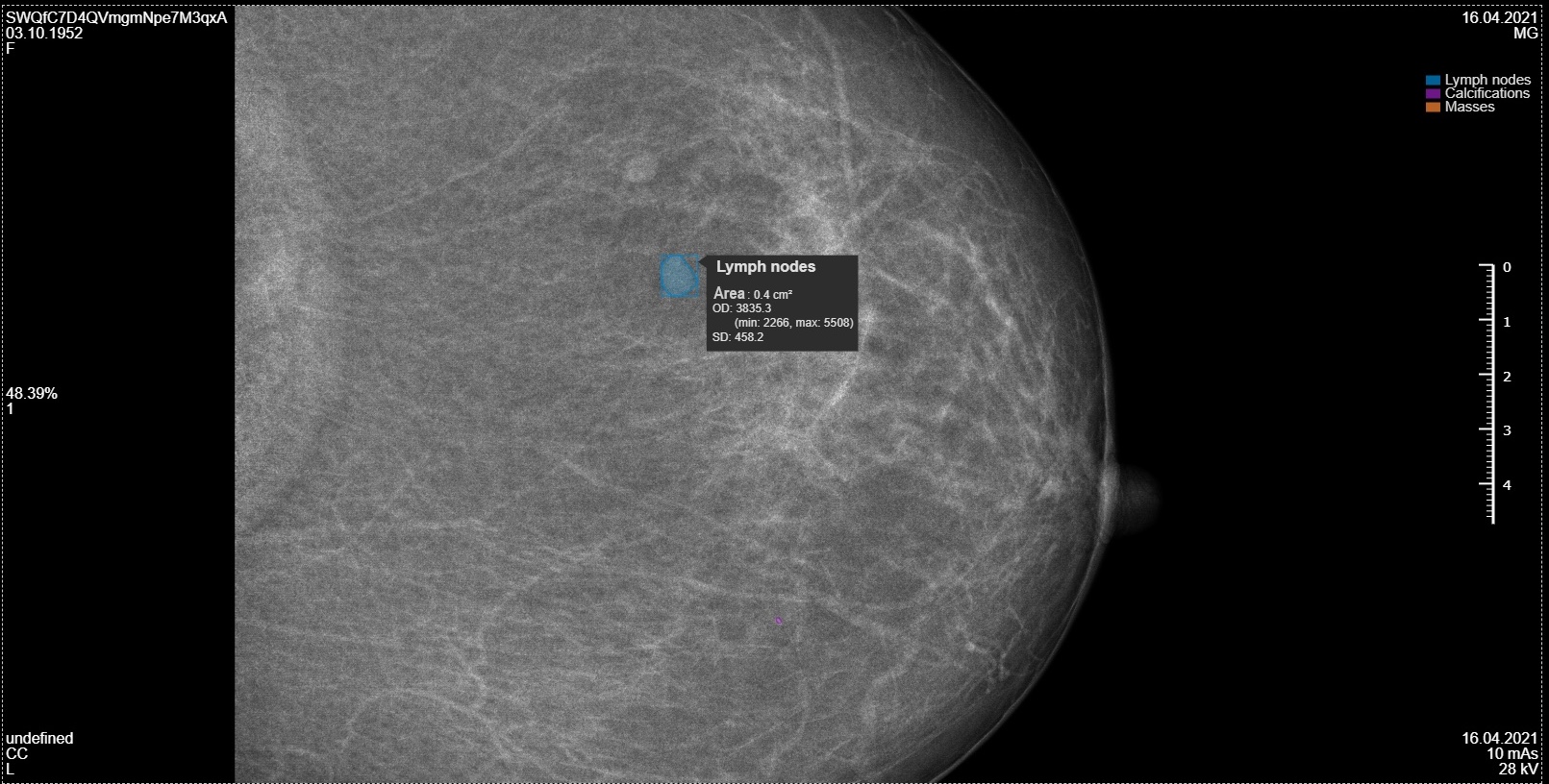 Lymph Node analysis