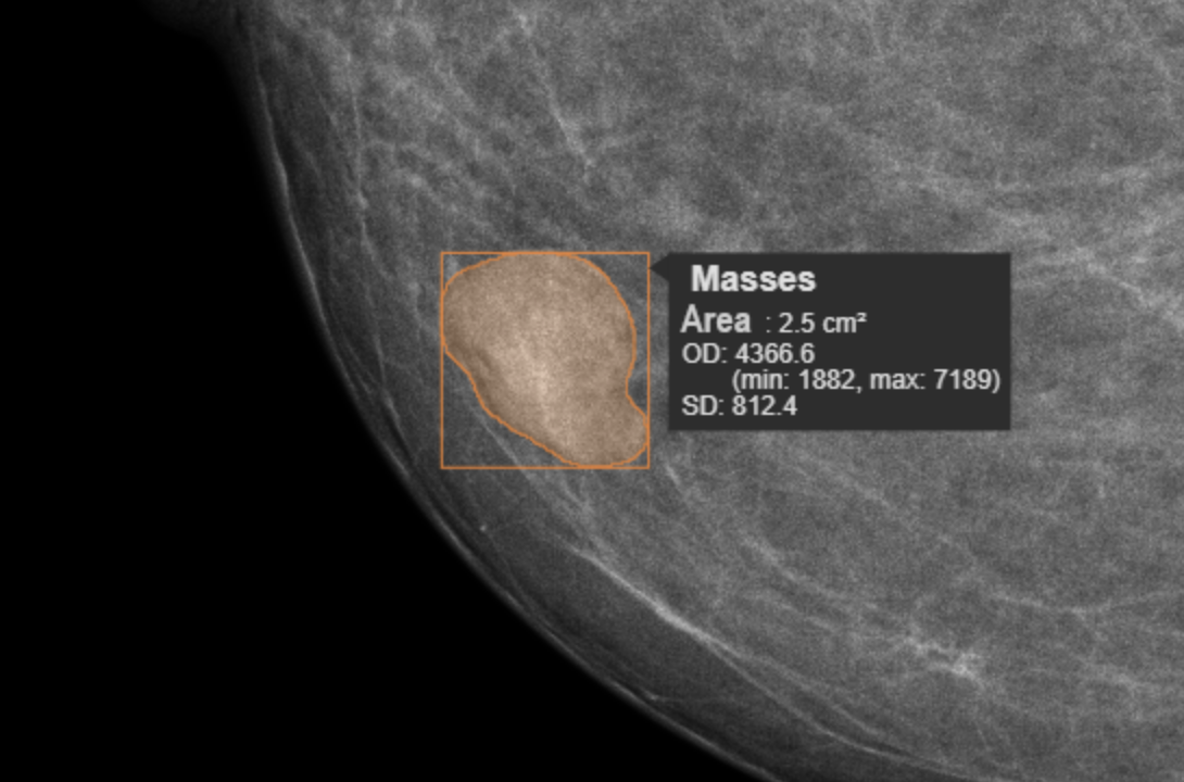 Transforming Mammography with AI Precision